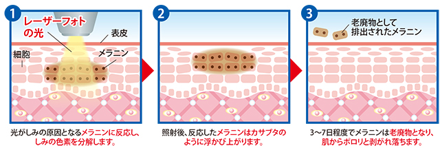 ケノンでシミ取り