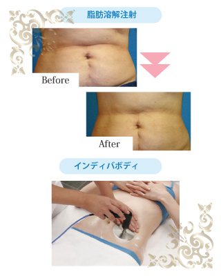 脂肪溶解注射 8本/インディバボディ40分2回