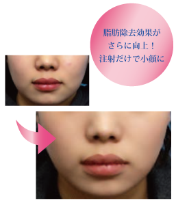 小顔・たるみ