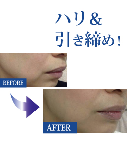吸収糸ファインリフト