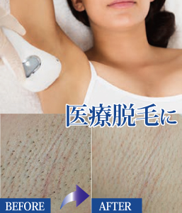 ハイグレード脱毛 クラリティ