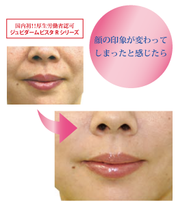 ヒアルロン酸注入